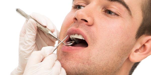 ¿Qué es la hipoplasia dental? ¿Qué es la hipoplasia dental?